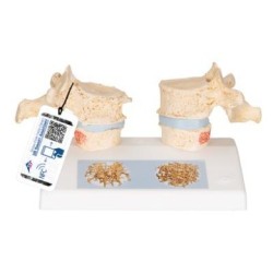 MODELO DE OSTEOPOROSIS A95