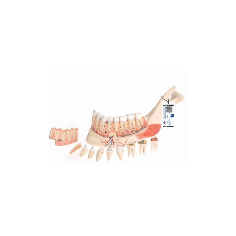 MODELO INTERACTIVO DE LA MANDÍBULA INFERIOR CON 8 DIENTES CARIADOS VE290