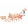 MODELO INTERACTIVO DE LA MANDÍBULA INFERIOR CON 8 DIENTES CARIADOS VE290