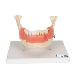 MODELO AFECCIÓN DENTAL A 2 AUMENTOS DE 21 PIEZAS