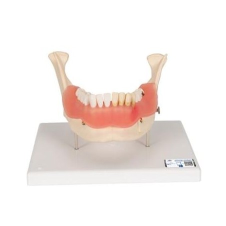 MODELO AFECCIÓN DENTAL A 2 AUMENTOS DE 21 PIEZAS